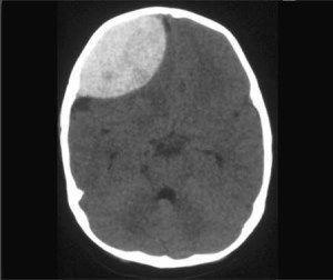 SUBDURAL-HEMATOMA