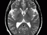 Grey Matter ~ Interpreting&nbsp;MRIs