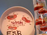 Settle Down. [No, not you…Erythrocyte Sedimentation Rate (ESR)&nbsp;]